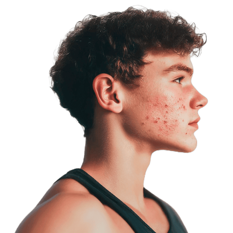 acne zaragoza tratamiento acne zaragoza tratamiento