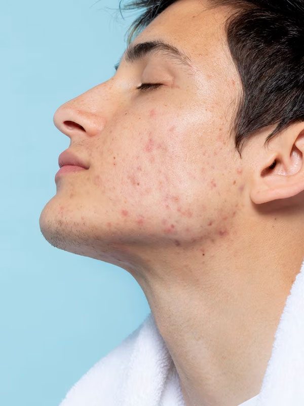 tratamiento acne hombre zaragoza tratamiento acne hombre zaragoza