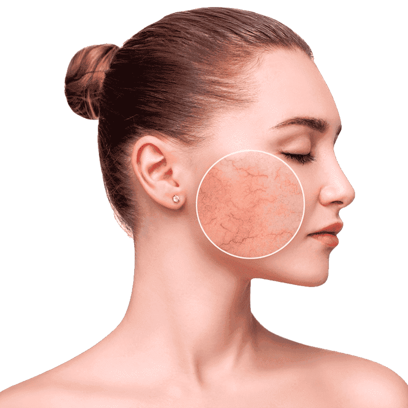 zaragoza cuperosis tratamiento