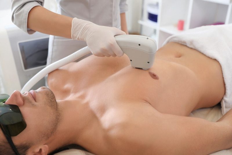 depilacion laser masculina