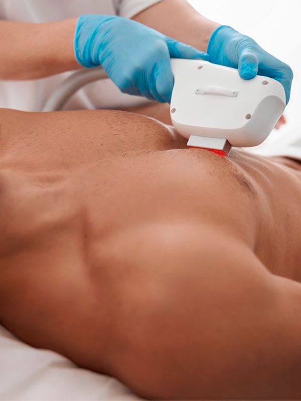 depilacion laser zaragoza hombres