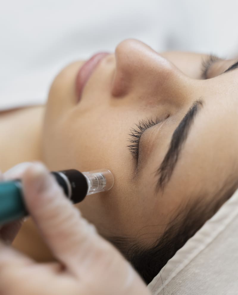 beneficios microneedling
