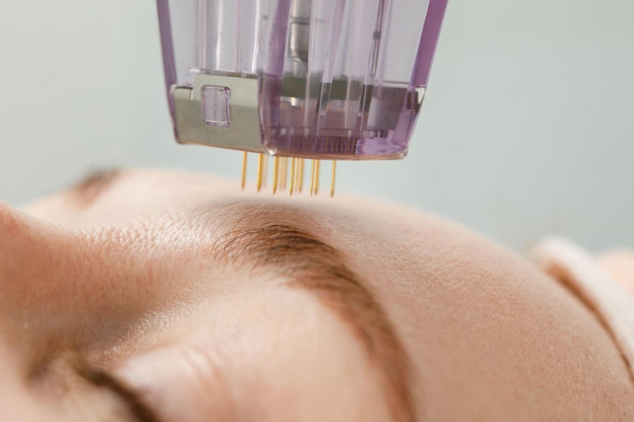para que sirve microneedling