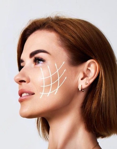 zaragoza lifting sin aguja